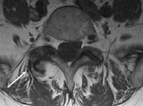 Facet Joint Arthropathy - Sports Medicine Review