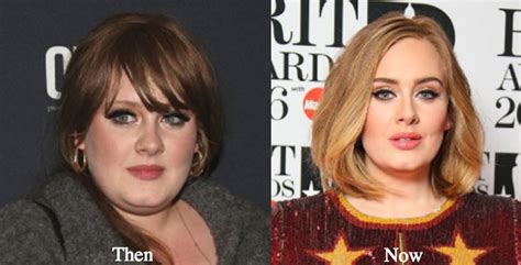 Adele’s Before and After Surgery Photos Show Proof of the Singer’s ...