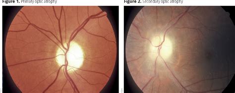 Optic nerve atrophy - MedTour