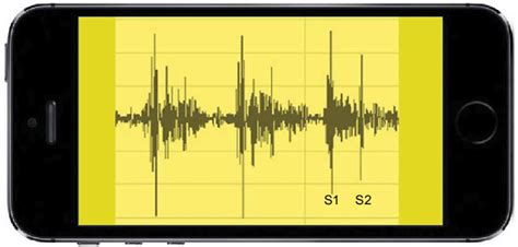 Simulated phonocardiogram of normal S1 and S2 heart sounds seen on a ...