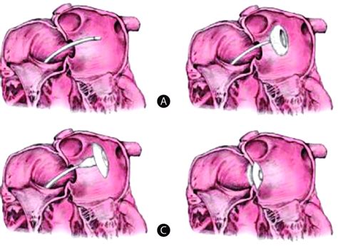 Schematic of patent foramen ovale (PFO) closure. Schematic illustrating ...