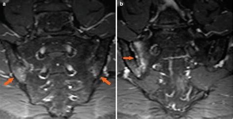 Psoriatic Arthritis | Radiology Key