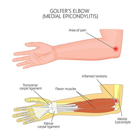 Golfer’s Elbow Causes & Treatment | FORM Hand, Wrist & Elbow Institute