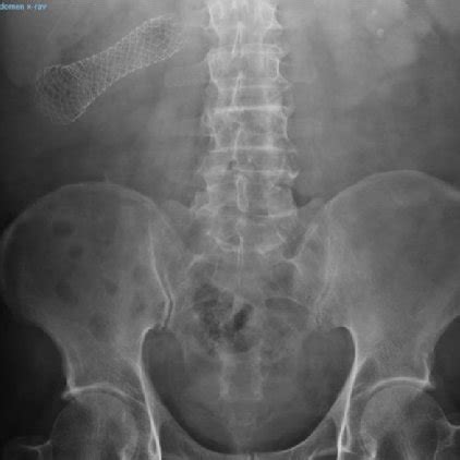 Post procedure X-ray colonic stent (sigmoid colon). | Download Scientific Diagram