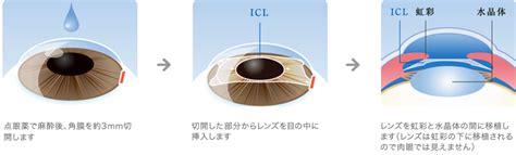 目にレンズを埋め込むICL手術とは？仕組みや特徴、歴史を経験者が徹底解説 | リモートライフハック！