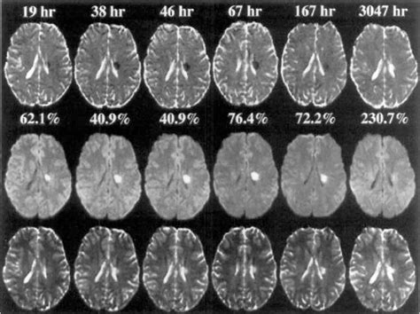 Time course of the apparent diffusion coefficient (ADC) abnormality in human stroke | Semantic ...