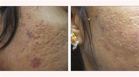 Cost Of Laser Acne Scar Removal Treatment - Cosmetic Surgery Tips