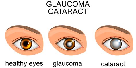 What are the Differences Between Cataracts and Glaucoma | Jason Gilbert, M.D.