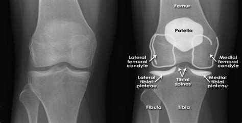 KNEE FRACTURES - Midwest Orthopaedics