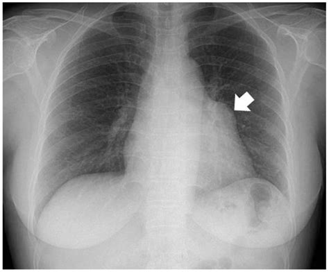 Abnormal Chest X Ray Results