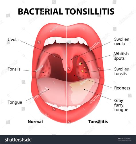 Tonsillitis Bacterial Angina Pharyngitis Tonsillitis Infection Stock Vector 214418923 - Shutterstock