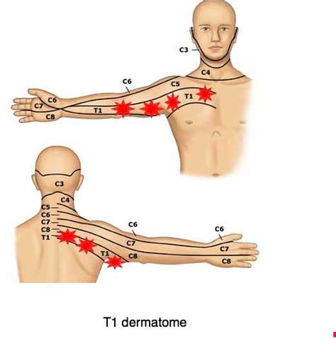 Nerve Pain: Nerve Pain Inner Upper Arm