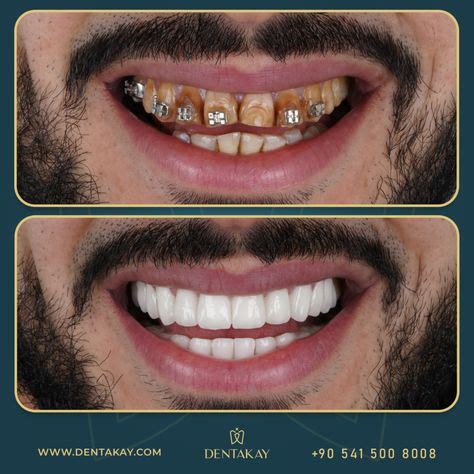 9 Hollywood smile Before and After ideas in 2021 | medical consultation ...