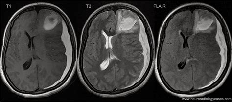 Brain Bleed: Brain Bleed On Mri