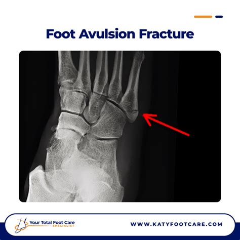 Foot Avulsion Fractures: Causes, Symptoms & Treatment | YTFCS