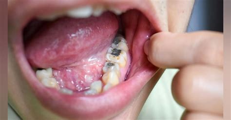 Study: Use of dental amalgam in fillings decreases 73% in 5 years ...