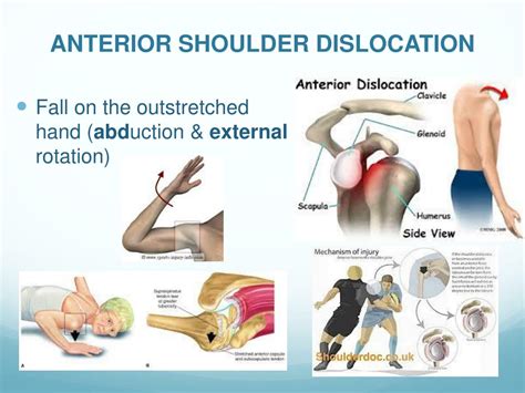 PPT - Acute Joint Dislocation PowerPoint Presentation, free download - ID:2415138