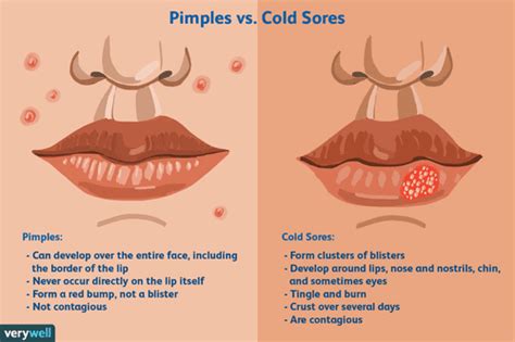 Is It a Cold Sore or Pimple?