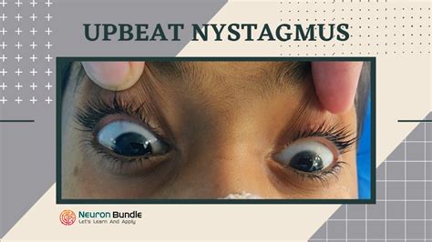 Classifying Nystagmus Neurology Eye Health Eye Facts - vrogue.co