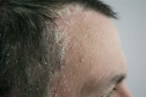 A Patient’s Guide to Scalp Psoriasis | Patient Advice | US News