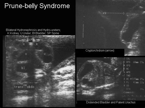 Prune Belly Syndrome Radiology