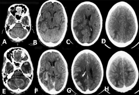 CT scan brain (plain and contrast images) showing multiple lesions... | Download Scientific Diagram