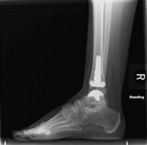 Total Ankle Replacement: Midwest Center for Joint Replacement: Hip and Knee Replacement Surgeons