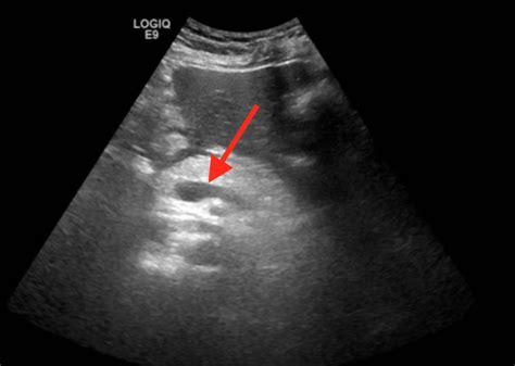 Cureus | Acute Pancreatitis Caused by Complications of Influenza A in the Setting of Chronic ...