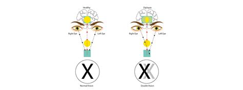 Double Vision | Ancaster Vision Therapy Center