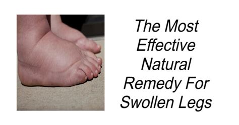 The Most Effective Natural Remedy For Swollen Legs