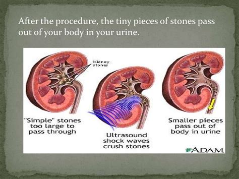 Lithotripsy