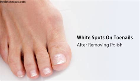 White Spots on Toenails After Removing Polish