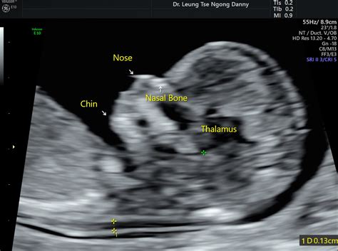 First Trimester Fetal Morphology Scan - HKOG-INFO