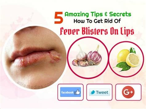 5 Tips How To Get Rid Of Fever Blisters On Your Lips Fast