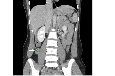 Appendicitis On Ct Scan