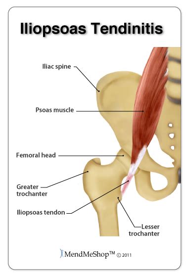 Tendinitis in the Hip