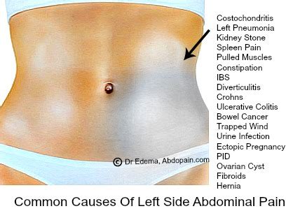 Left Side Abdominal Pain: Causes, Diagnosis & Treatment | ABDOPAIN.com