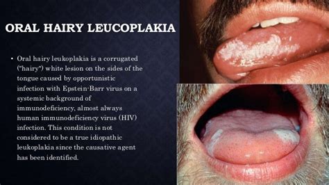 Leukoplakia