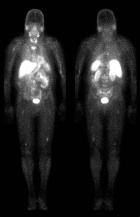 legend: The image on the left is a MIBI scan that demonstrates high... | Download Scientific Diagram