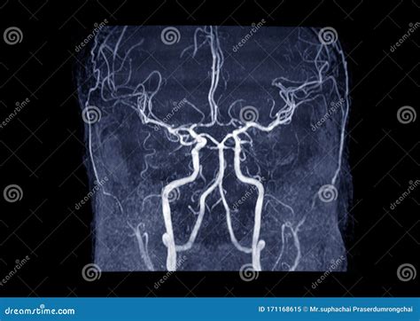 MRA Brain or Magnetic Resonance Angiography MRA of Cerebral Artery in the Brain. Stock Image ...