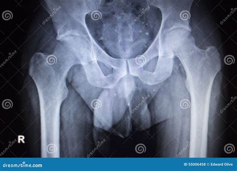 X-ray Orthopedic Scan Image Of Hip Joints Human Skeleton Stock Photo - Image: 55006458