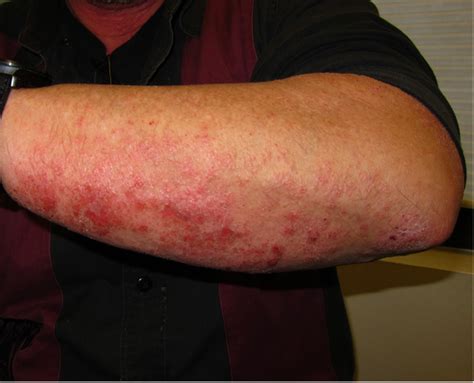 Chronic Actinic Dermatitis treatment with Dupilumab: A Case Report and Review of the Literature ...