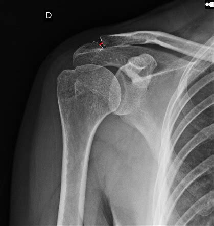 Acromioclavicular Joint X Ray