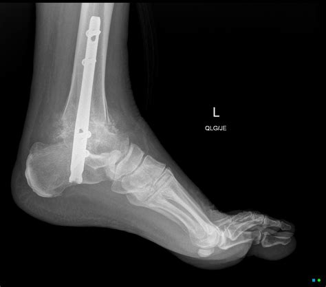 Tibiotalocalcaneal (TTC) arthrodesis | Image | Radiopaedia.org