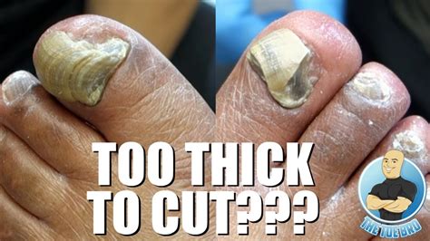 TRIMMING EXTREMELY THICK TOENAILS - FULL TREATMENT - YouTube