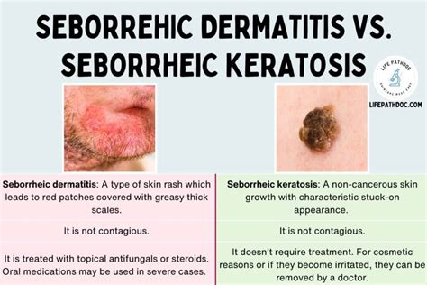 Seborrheic Dermatitis vs. Seborrheic Keratosis (with Pictures)