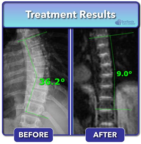 Adult Scoliosis