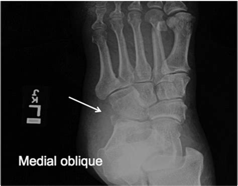 Avulsion fractures in the foot: telltale radiographic signs to avoid ...