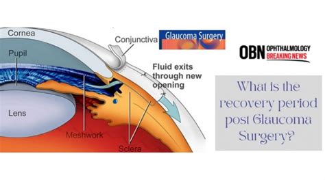 Recovery After Glaucoma Surgery | OBN