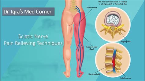 How to do Sciatic Nerve Flossing| Sciatic Nerve Flossing for Tension ...